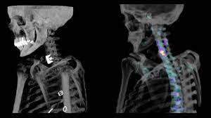 How to interpret CT bone scans: 3 Essential Methods