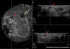 How to Interpret Breast Ultrasounds: 3 Essential Methods