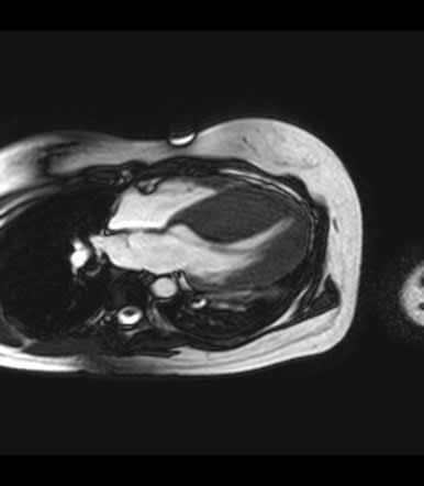 How to Interpret Cardiac MRIs: 3 Essential Techniques