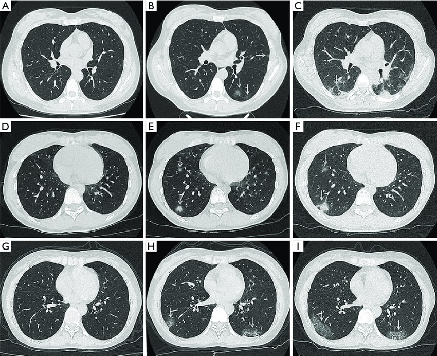 How to interpret chest CT scans: 3 Essential Methods