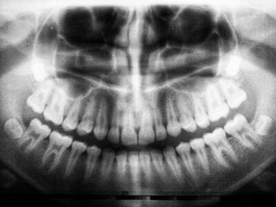 How to interpret dental X-rays: 3 Essential Methods