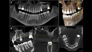 How to Interpret Dental CT Scans: 3 Essential Methods