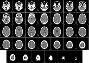How to interpret head CT scans: 3 Essential Methods