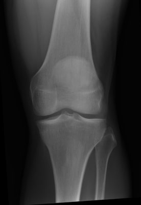 How to interpret knee X-rays: 3 Essential Methods
