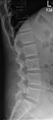 How to interpret Lumbar Spine X-rays: 3 Essential Methods