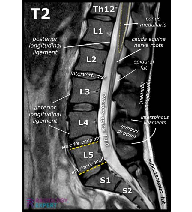 How to Interpret Lumbar Spine MRIs: 3 Essential Techniques