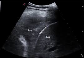 How to Interpret Lung Ultrasound: 3 Essential Methods