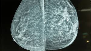 How to Interpret Mammograms: 3 Essential Methods