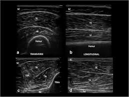 How to Interpret Muscle Ultrasounds: 3 Key Techniques