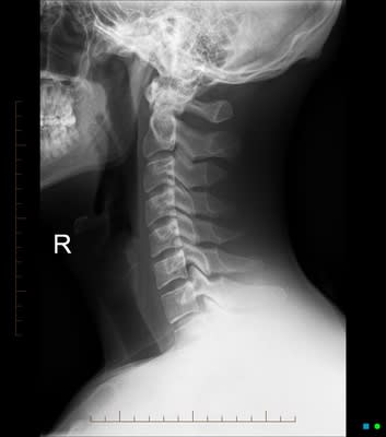 How to interpret neck X-rays: 3 Essential Methods