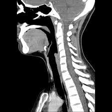 So interpretieren Sie Nacken-CT-Scans: 3 wesentliche Methoden
