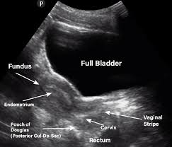 How to Interpret Pelvic Ultrasounds: 3 Essential Methods