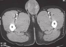 Wie man Scrotum-CT-Scans interpretiert: 3 wichtige Methoden
