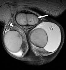 How to Interpret Scrotal MRIs: 3 Essential Techniques