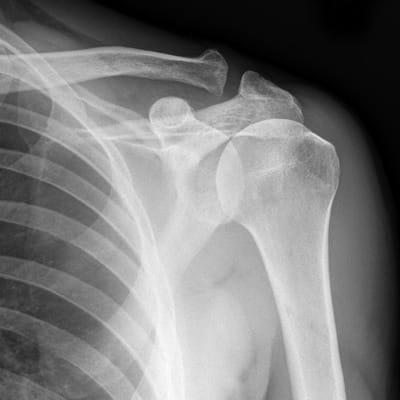 How to interpret shoulder X-rays: 3 Key Techniques