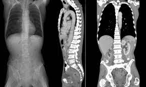 How to interpret spine CT scans: 3 Essential Methods