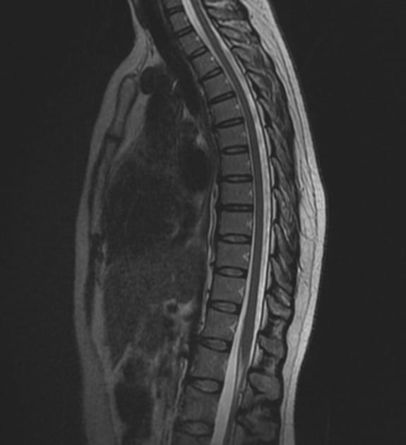 How to Interpret Thoracic Spine MRIs 3 Essential Techniques