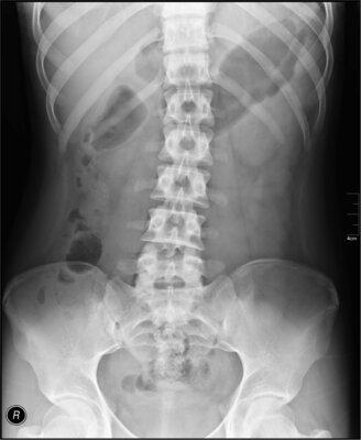 picture of a abdominal xray