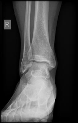 picture of a ankle xray