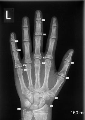 picture of a bone-age xray