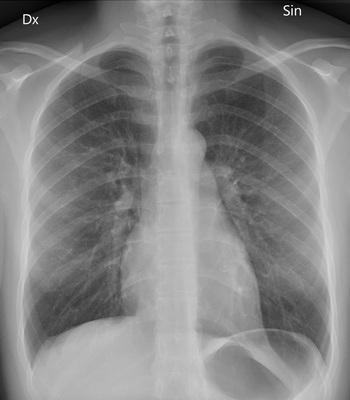 picture of a chest xray