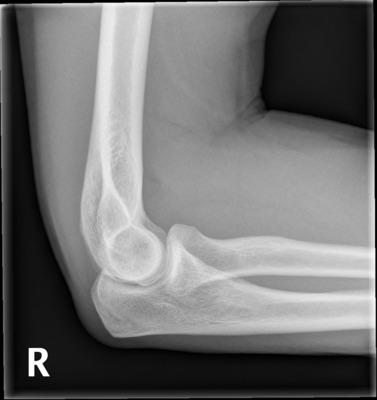 picture of a elbow xray
