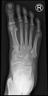 picture of a foot xray