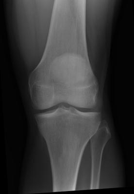 picture of a knee xray