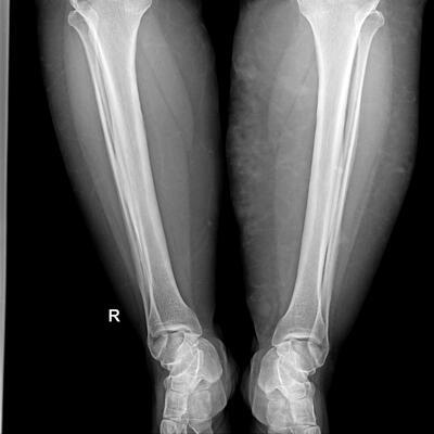 picture of a leg xray