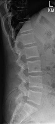 picture of a lumbar-spine xray