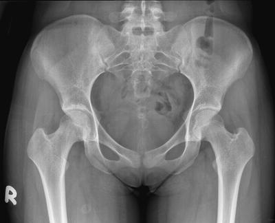 picture of a pelvic xray