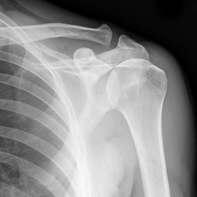 picture of a shoulder xray