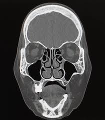 picture of a sinus xray