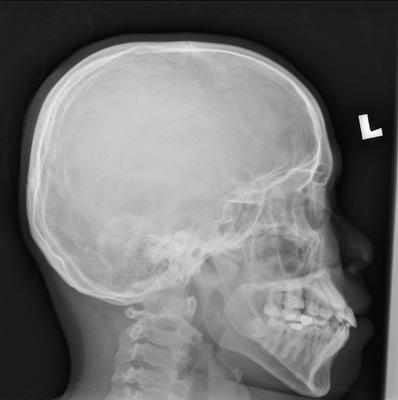 picture of a skull xray