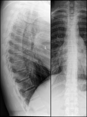 picture of a thoracic-spine xray