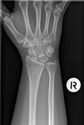 picture of a wrist xray