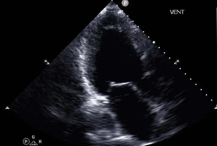 AI Model Uses Cardiac Ultrasound to Diagnose Advanced Heart Failure