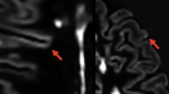 AI Technique Unveils Previously Hidden MS Gray Matter Lesions on MRI
