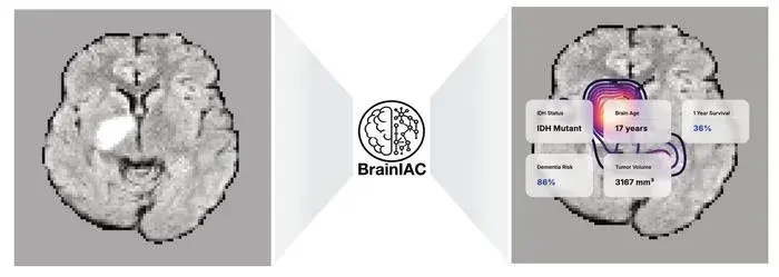 BrainIAC AI Model Excels in Brain MRI Analysis and Disease Prediction