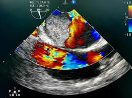 Example of an Echocardiogram