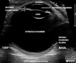 Example of an Eye Ultrasound