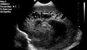 Ejemplo de un Ultrasonido Craneal Neonatal