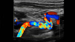 Example of a Vascular Ultrasound