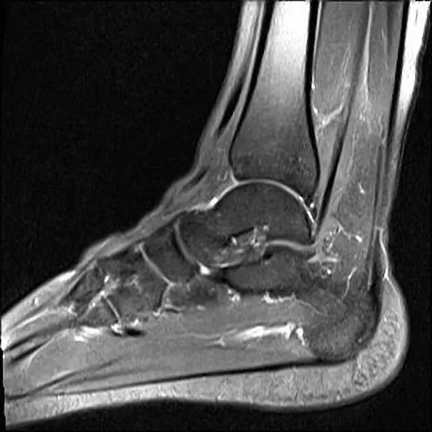 Ön Talofibular Ligamentin Örnek MRI'si