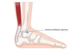 Ön Talofibular Ligamentin Pozisyonu