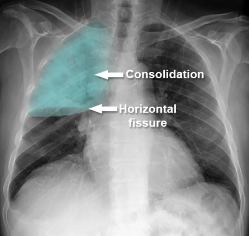 Normal Vs Abnormal Chest X Rays What Do They Reveal Normal Vs Abnormal Chest X Rays What Do They Reveal
