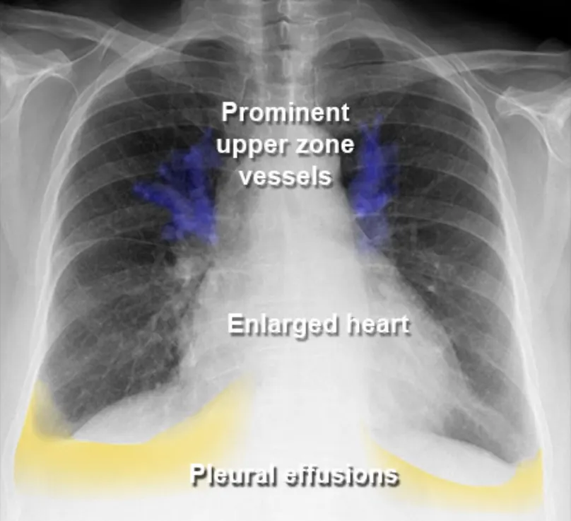 Chest X-ray with pleural effusion, displaying blurring of lung borders