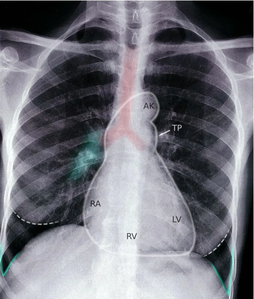 A normal chest X-ray highlighting a normal-sized heart