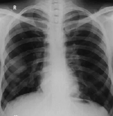 A normal chest X-ray showing clear lung fields