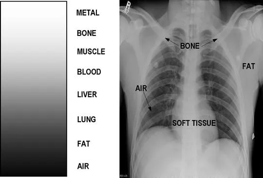 A normal chest X-ray highlighting Soft tissues